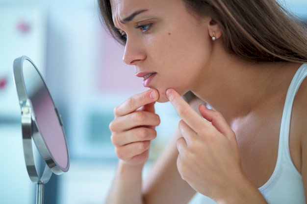 Five Foods  That Worsen Your Acne Skin Issue